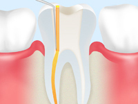 虫歯の治療法